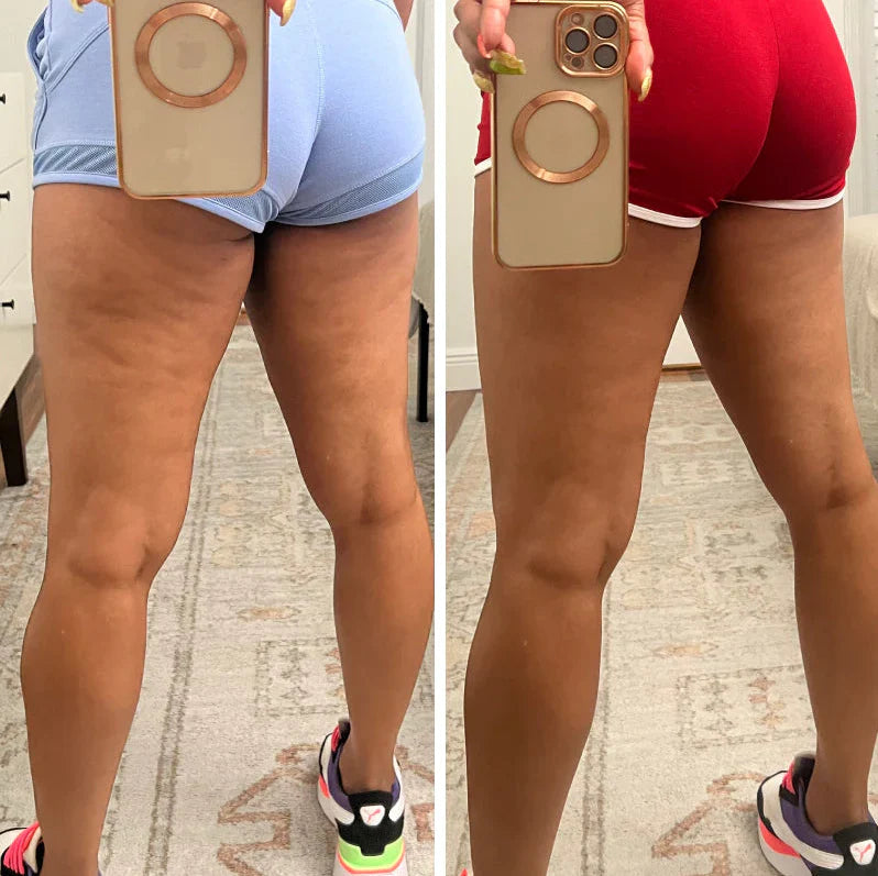 Anti-Cellulite Therapy Massager